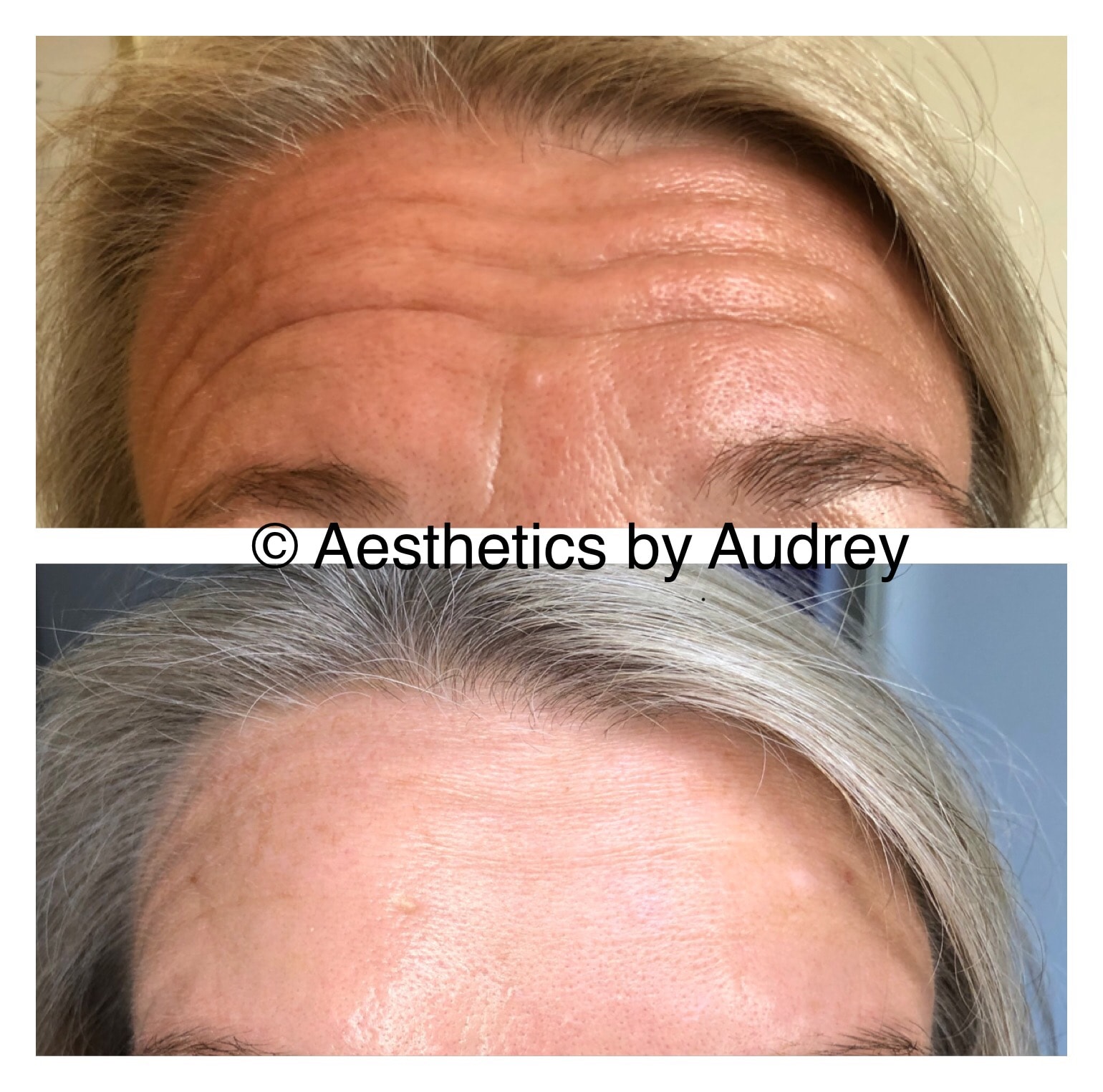 Botox — Forehead Lines