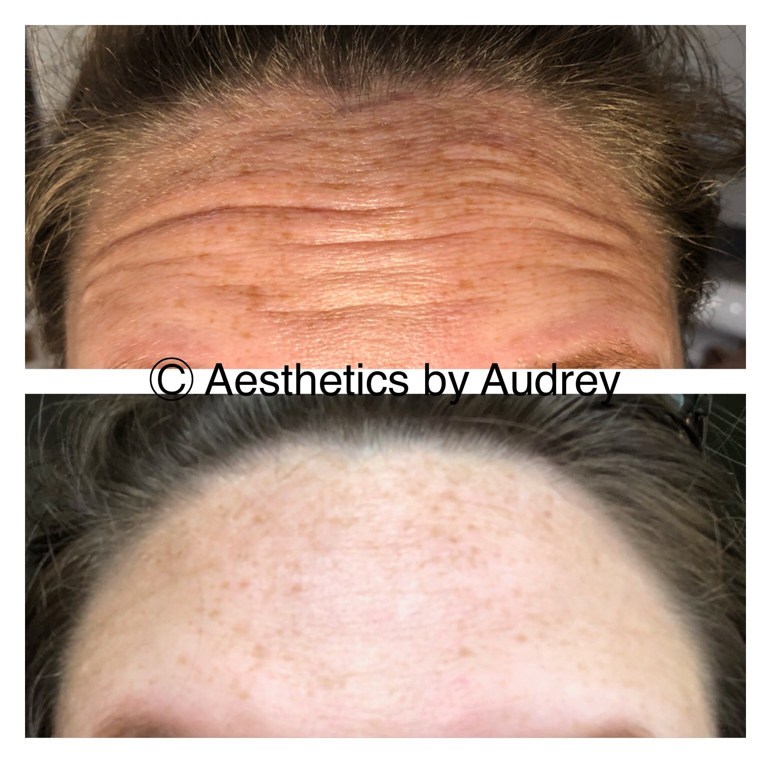 Botox — Forehead Lines