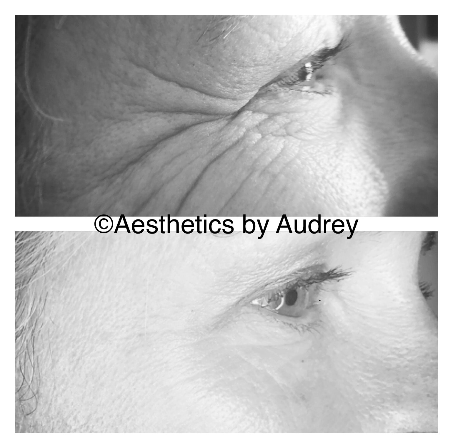 Botox — Crow's Feet