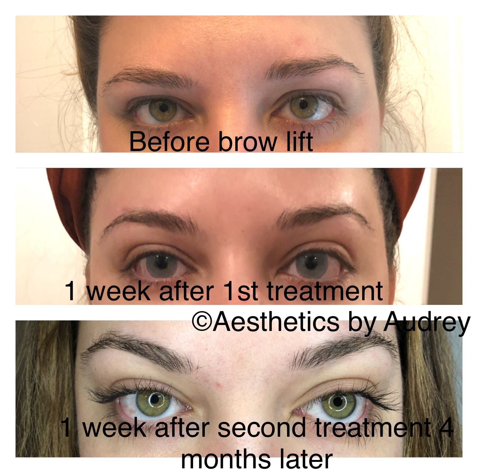Botox — Brow Lift