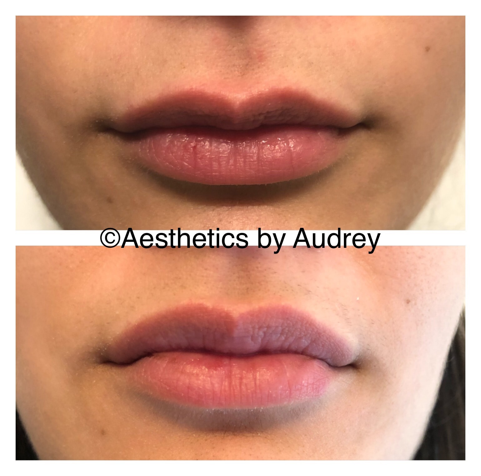 Lower Facial Line Filler