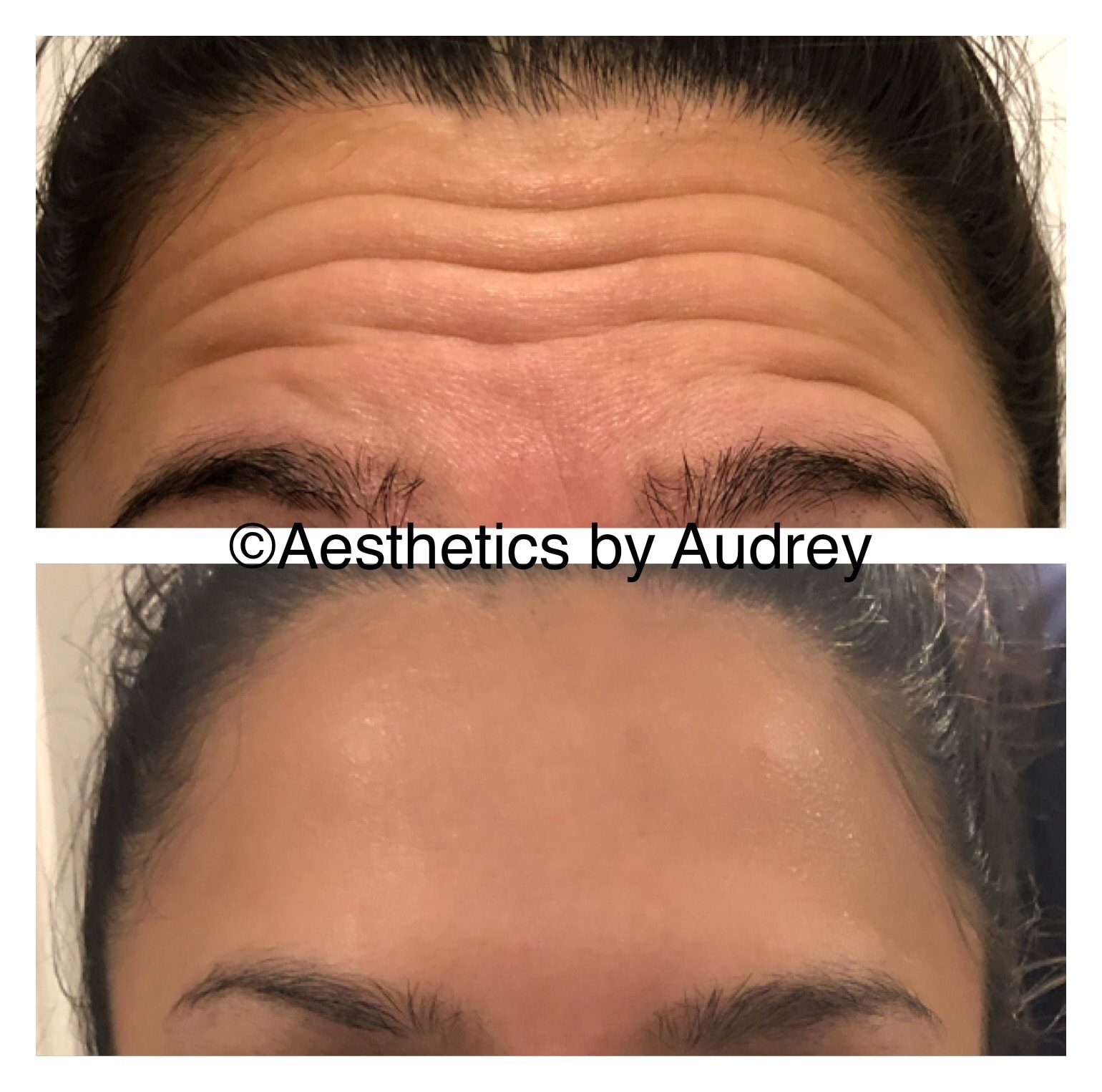 Botox — Forehead Lines
