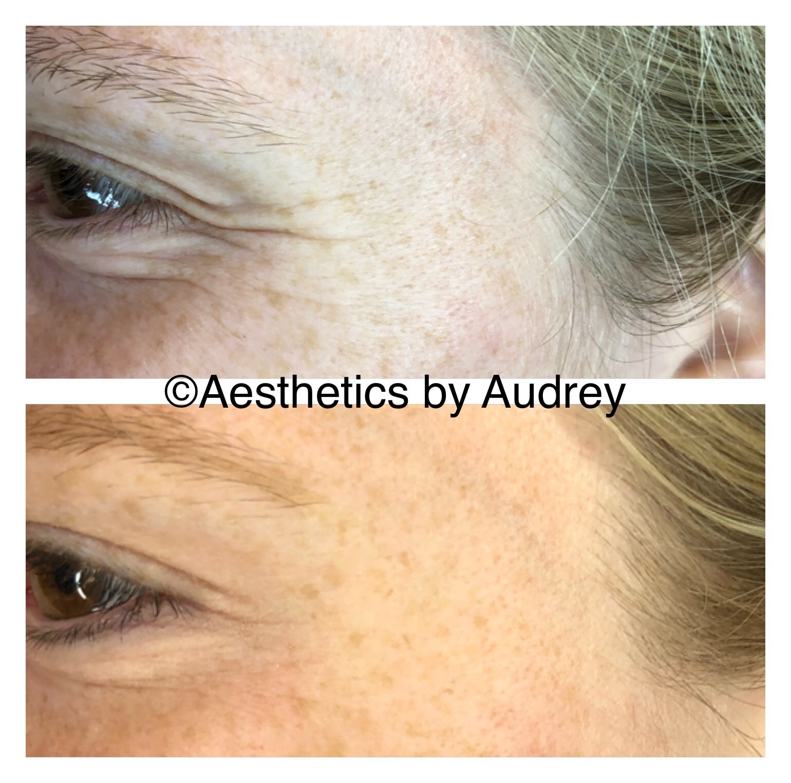 Botox — Crow's Feet