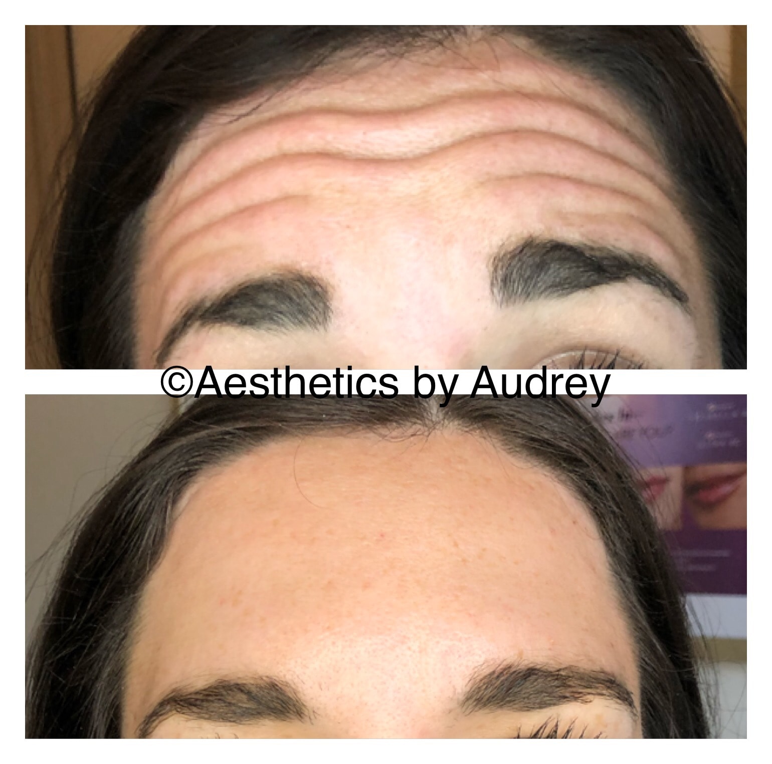 Botox — Forehead Lines