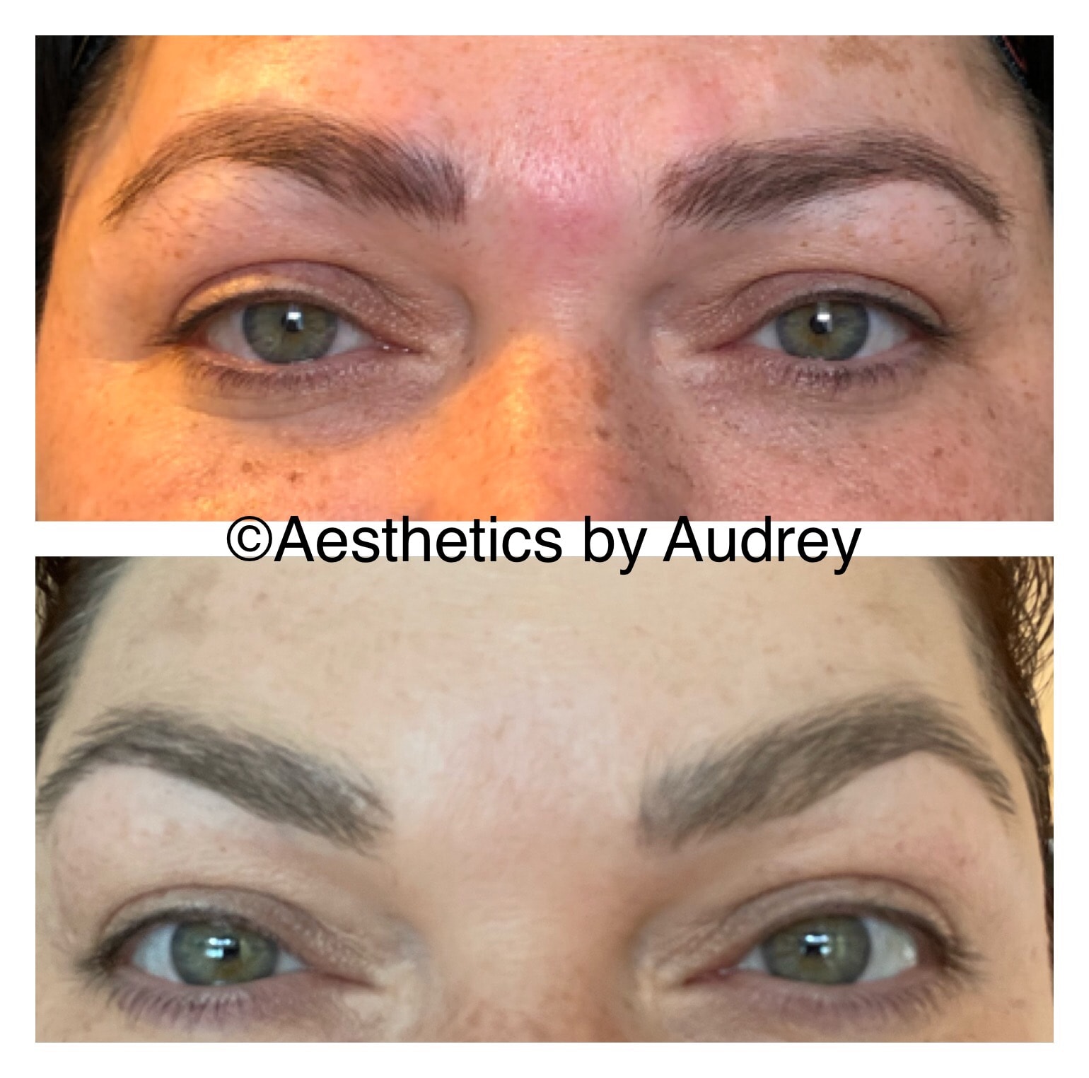 Botox — Brow & Eye Area