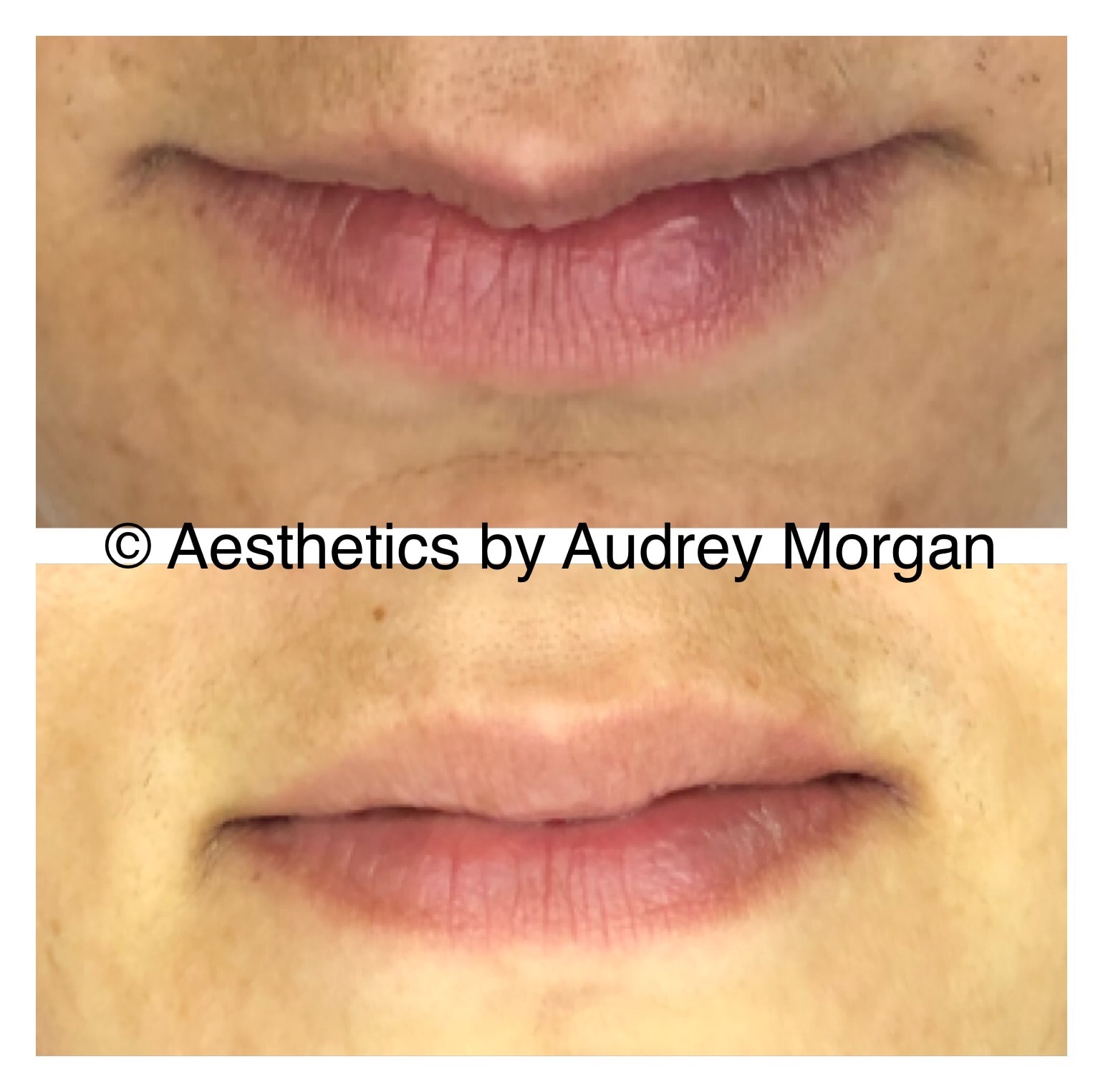 Botox — Lip Flip