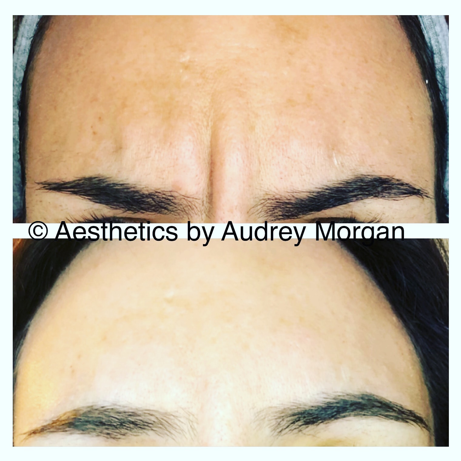 Botox — Glabellar Lines