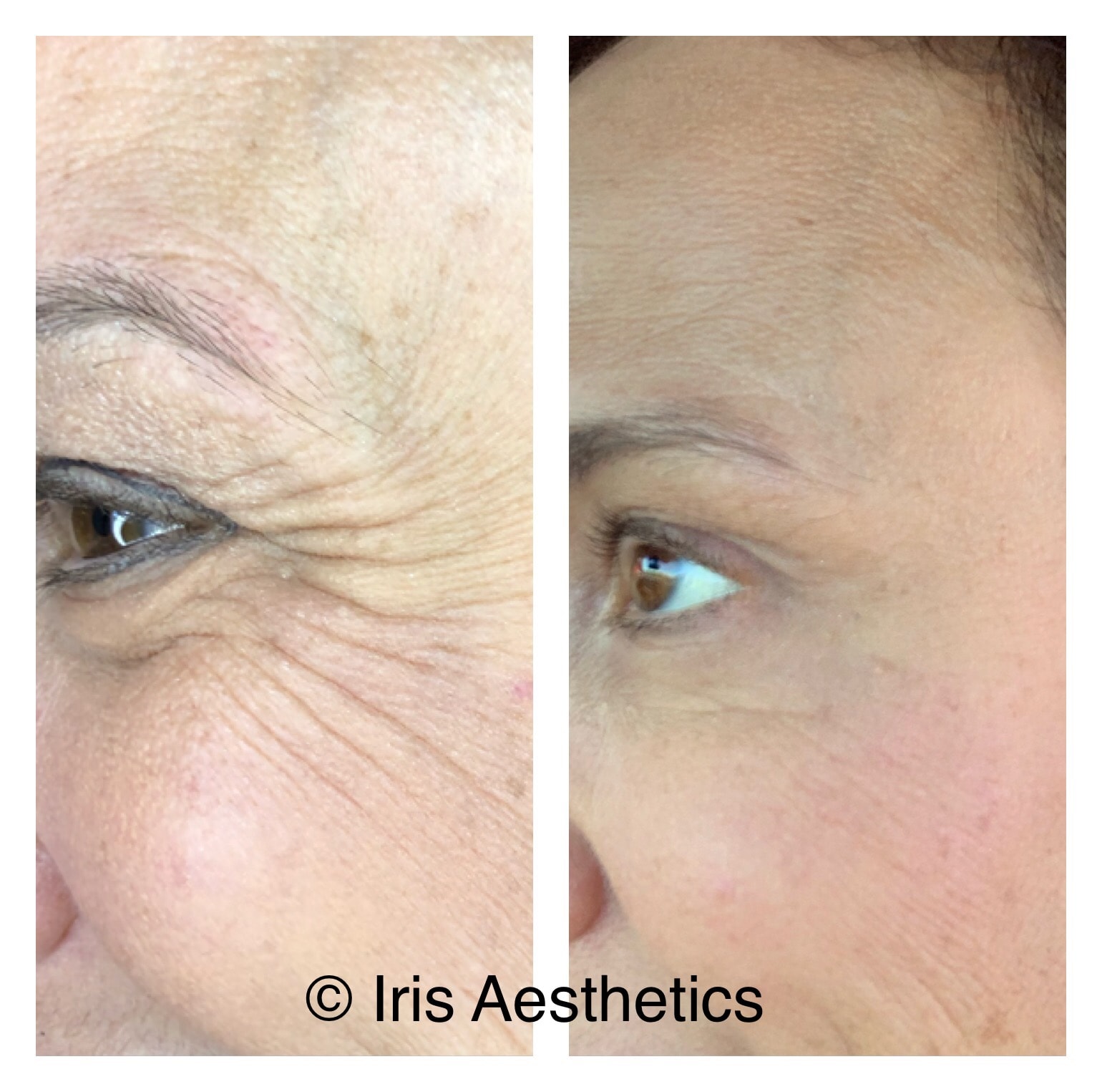 Botox — Crow's Feet
