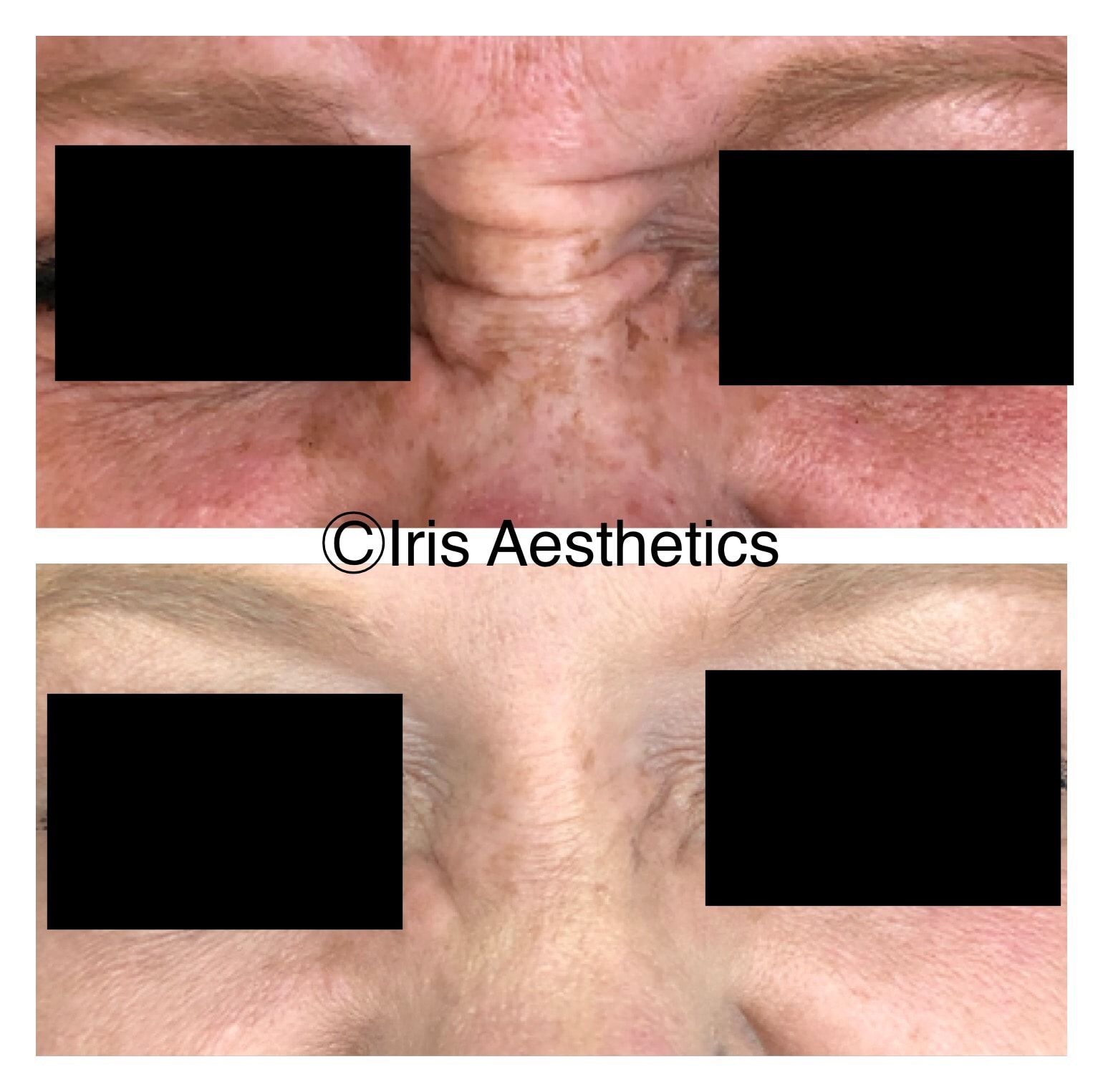 Botox — Forehead Lines