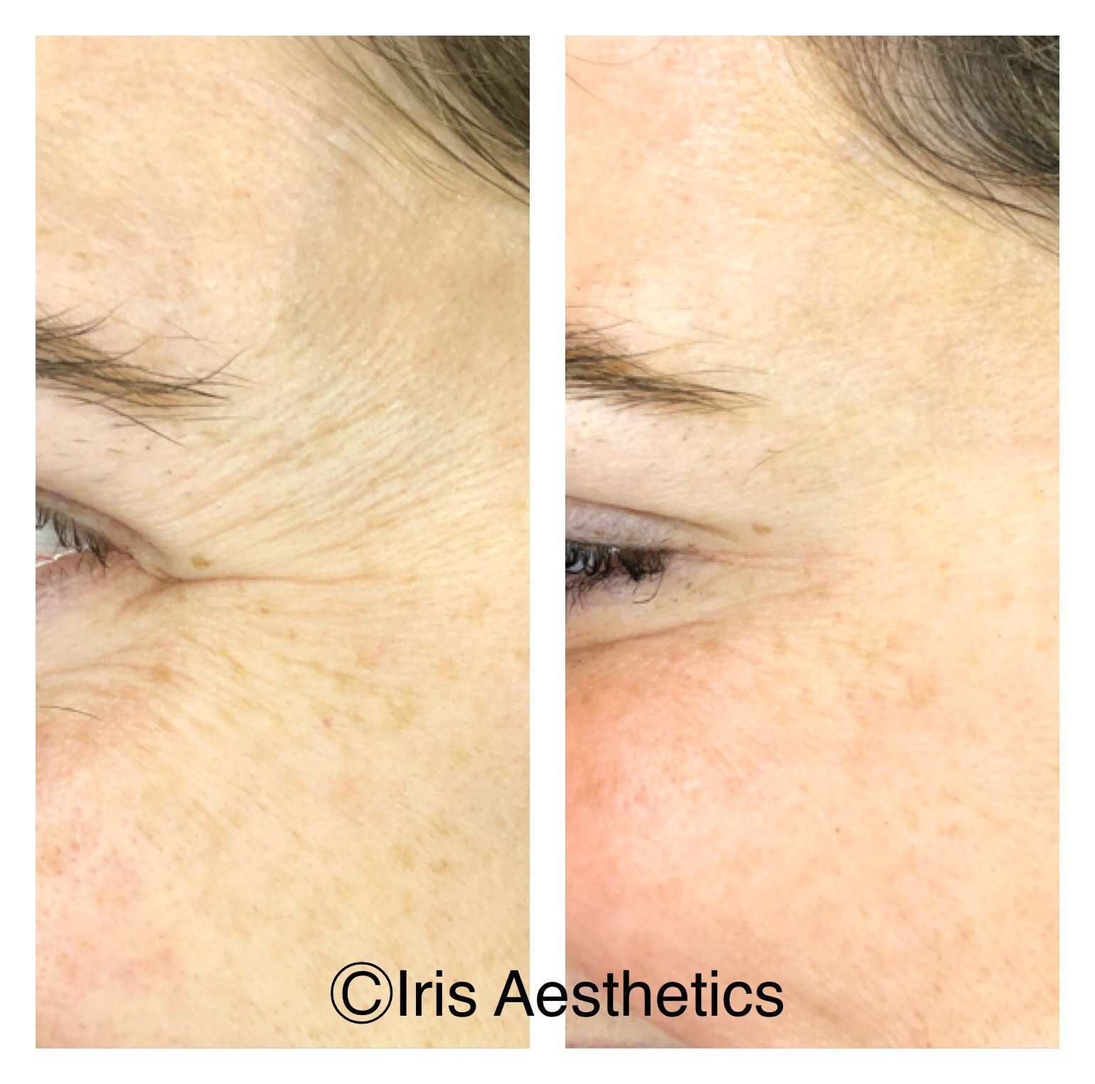 Botox — Forehead & Glabella