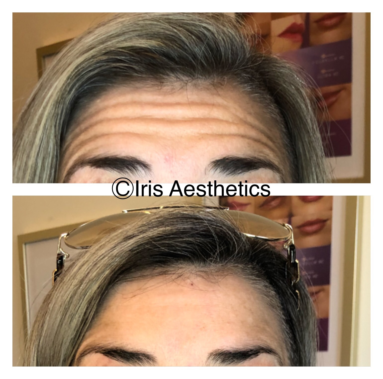 Botox — Crow's Feet