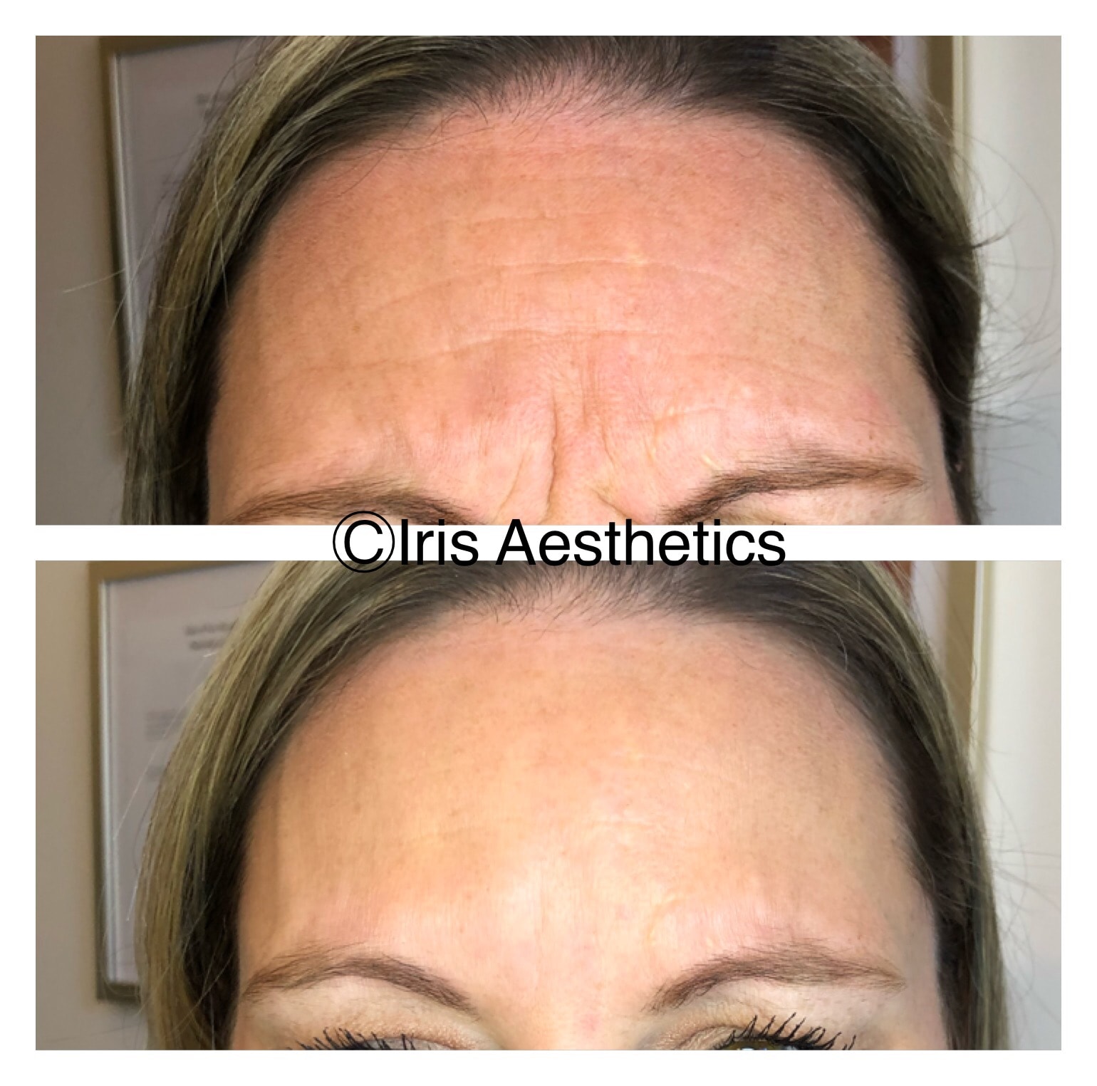 Botox — Forehead Lines