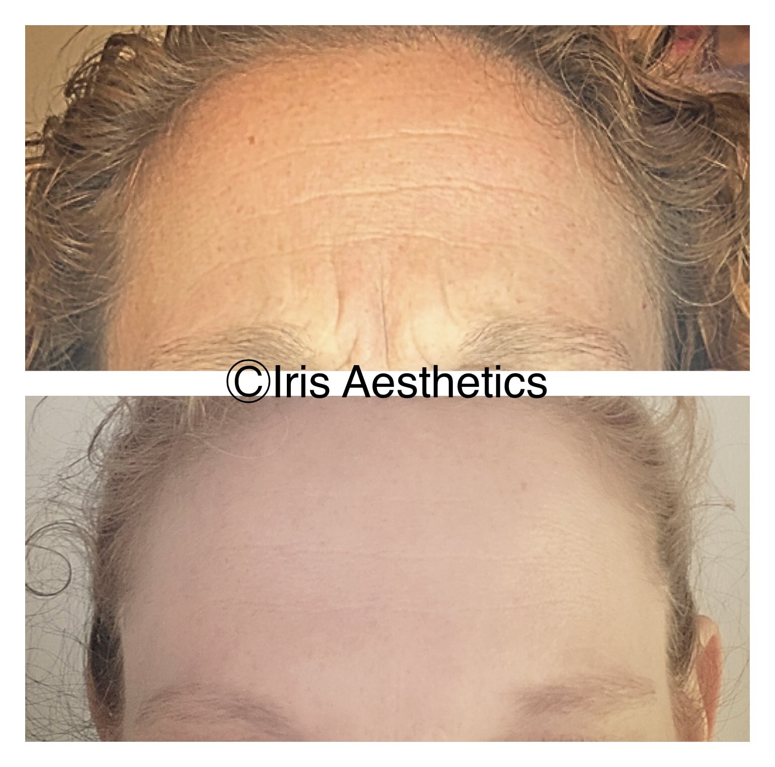 Botox — Forehead Lines