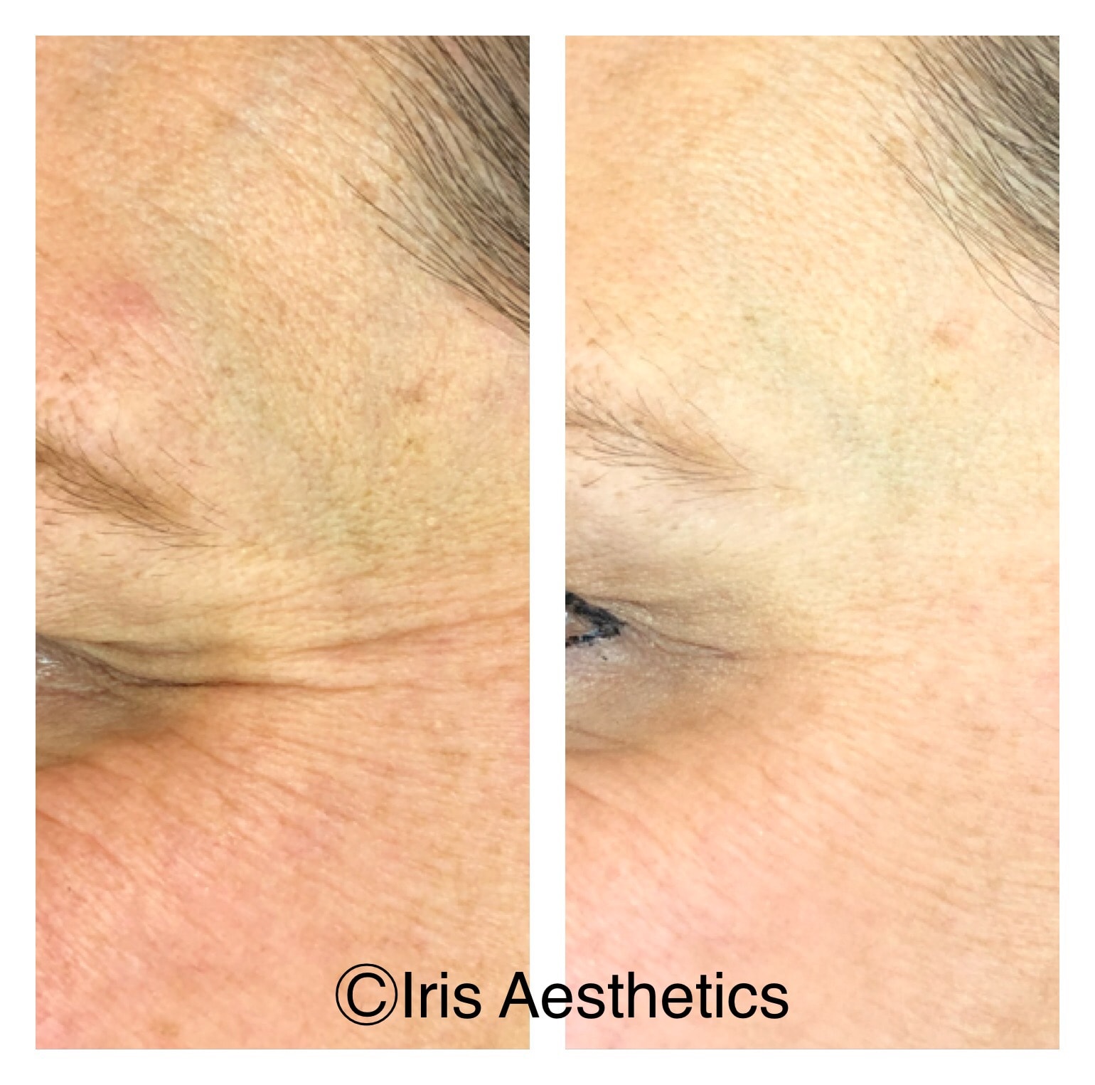 Botox — Crow's Feet