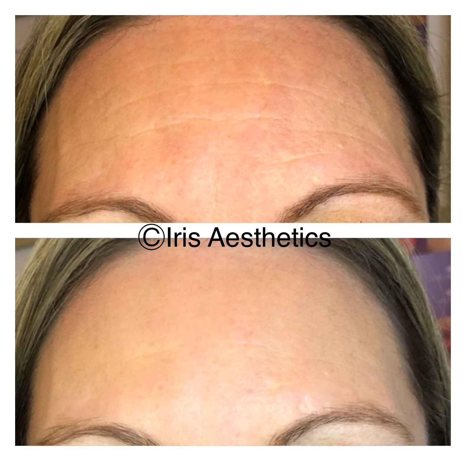 Botox — Forehead Lines