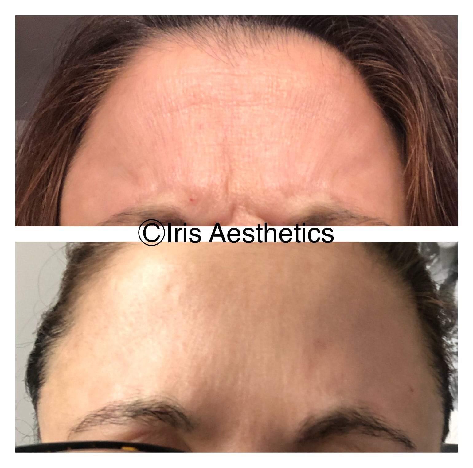 Botox — Forehead & Glabella