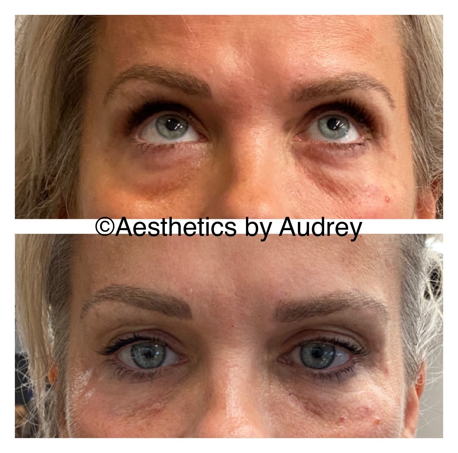 Under-Eye Filler — Tear Trough