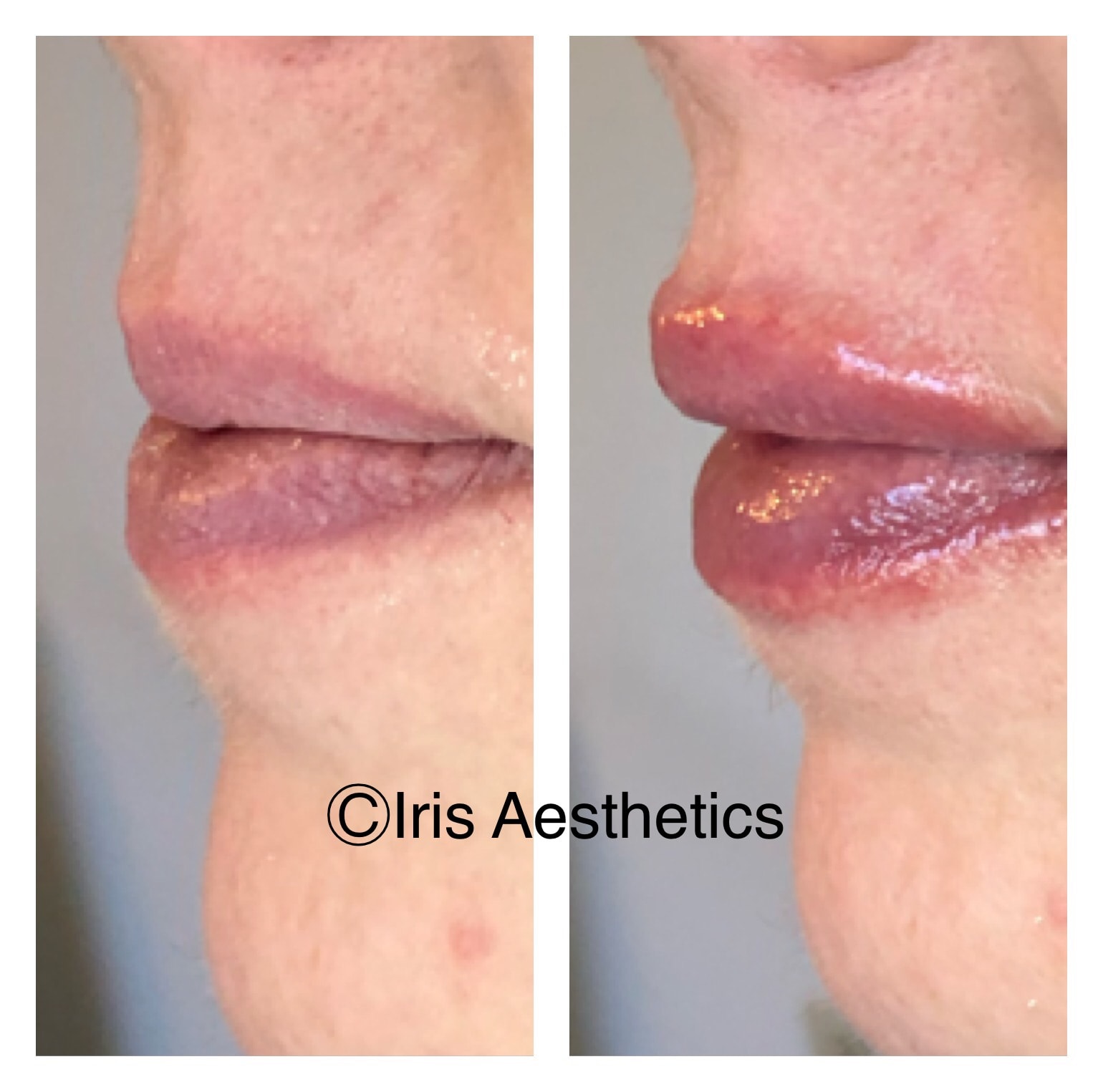 Lip Filler — Side Profile
