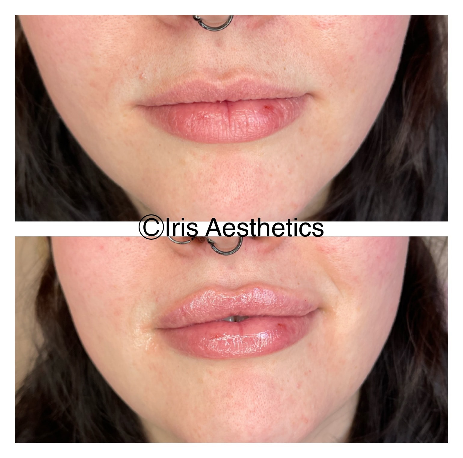 Lip Filler — Front View
