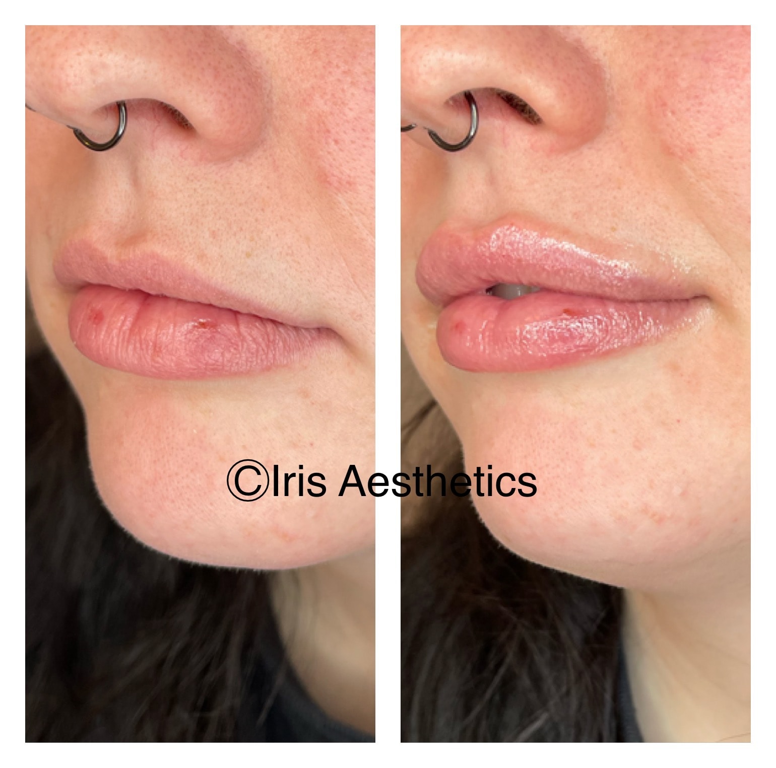 Lip Filler — 3/4 Angle