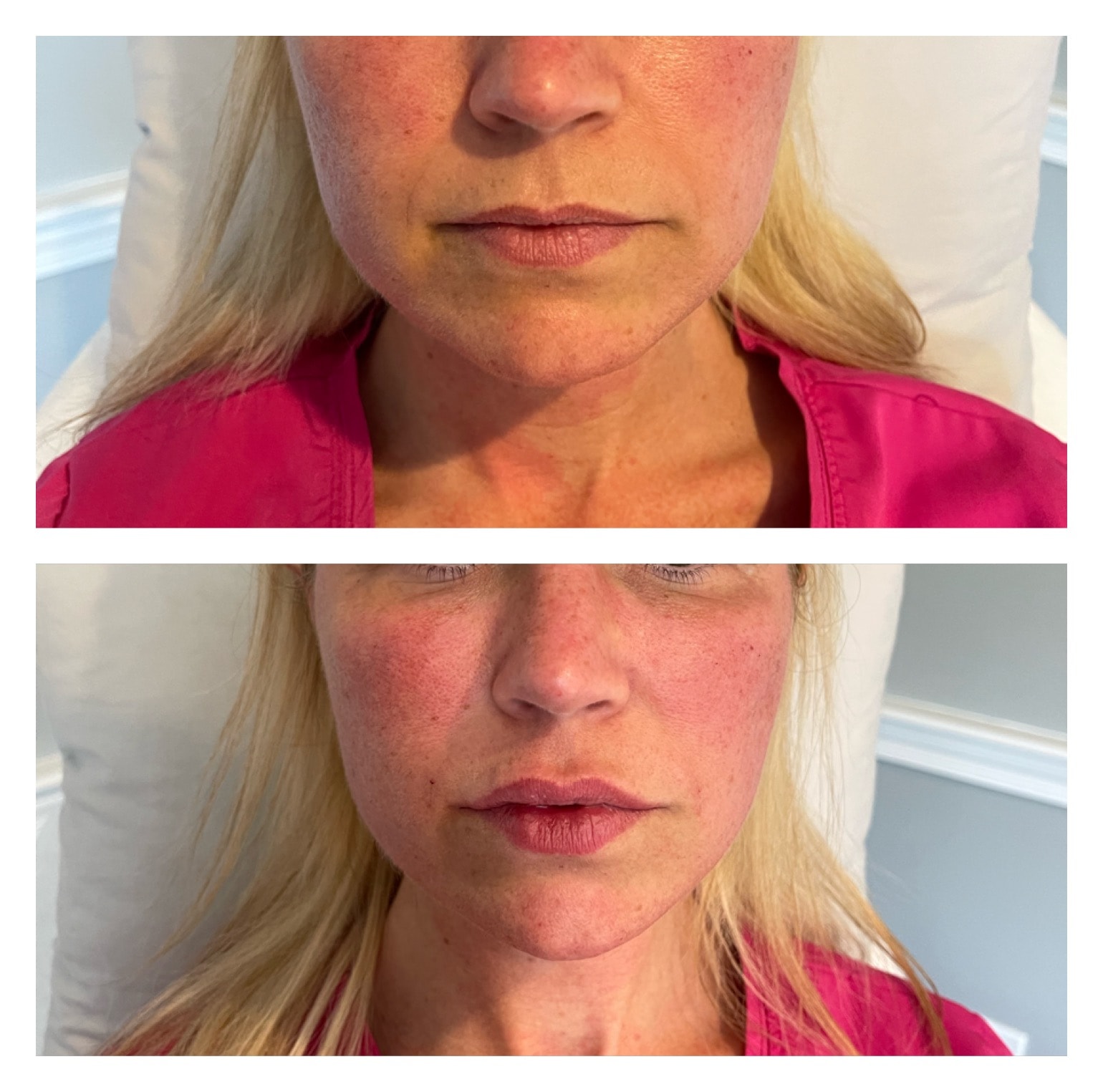 Lip Filler — Multi-Angle