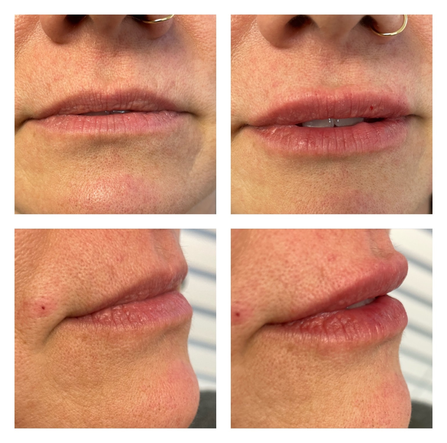 Perioral Filler