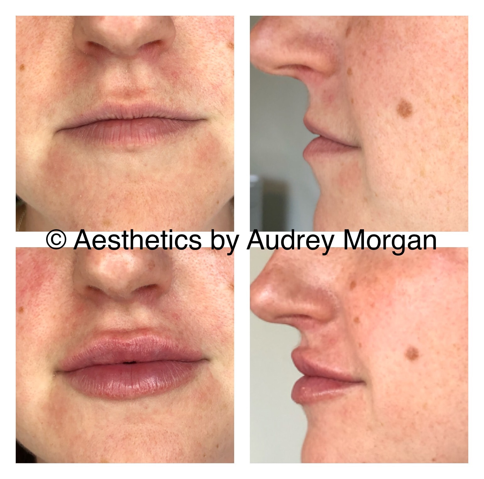 Lip Filler — Front & Side View