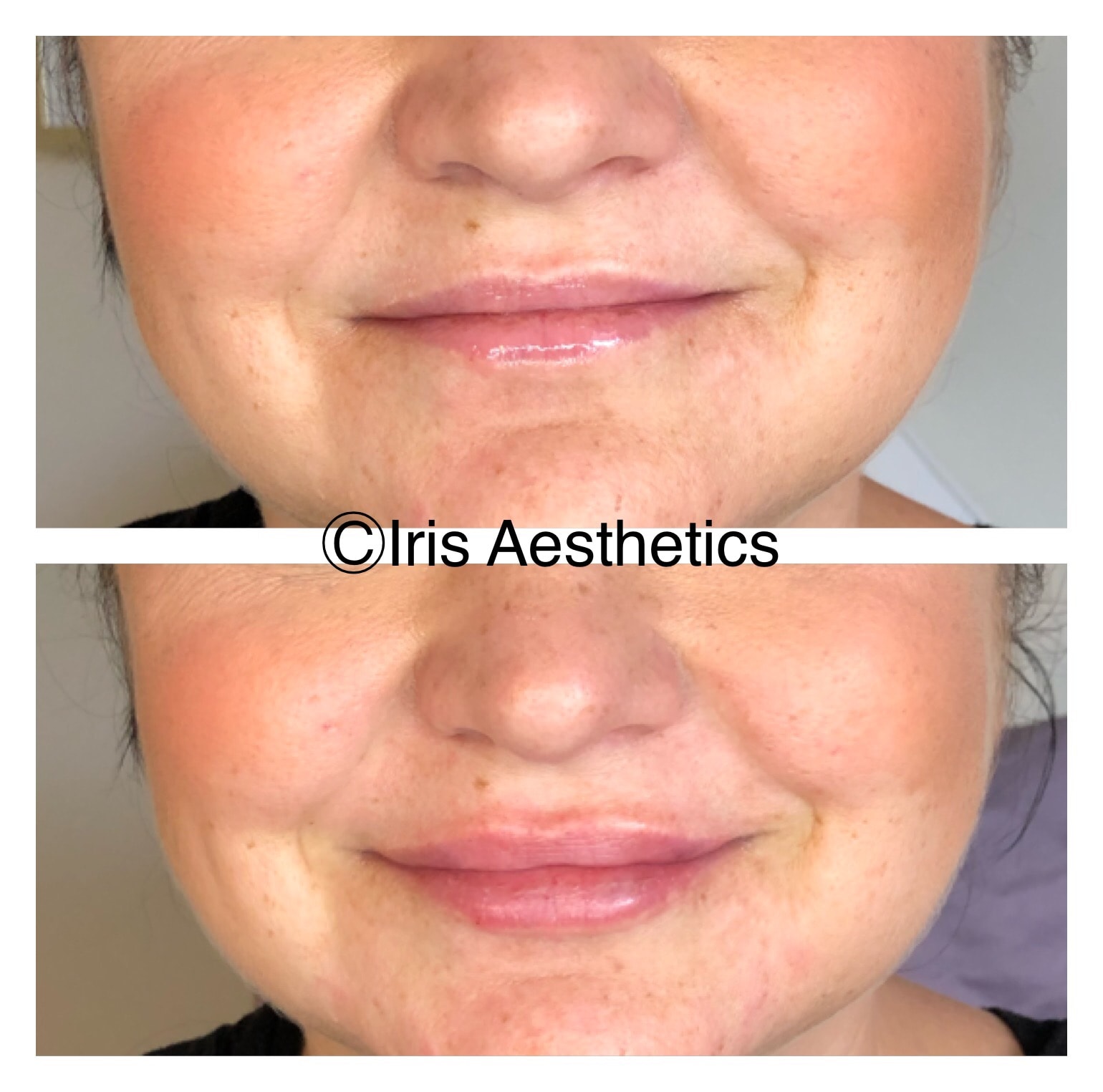 Lip Filler