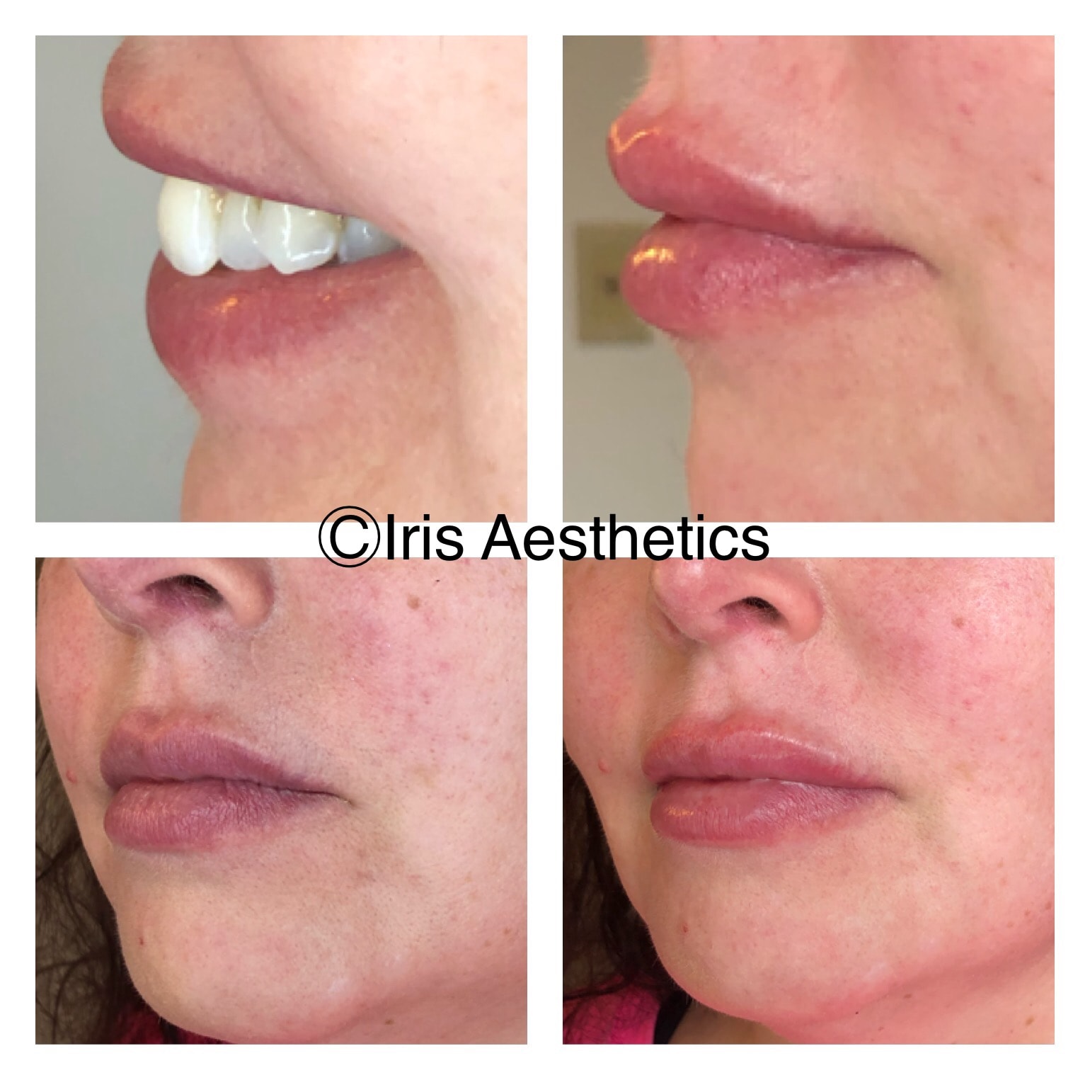 Lip Filler — Side Profile
