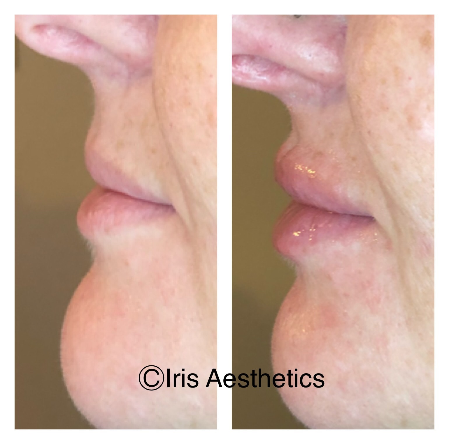 Lip Filler