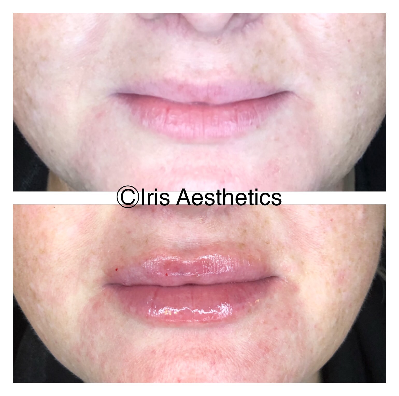 Lip Filler — Side Profile
