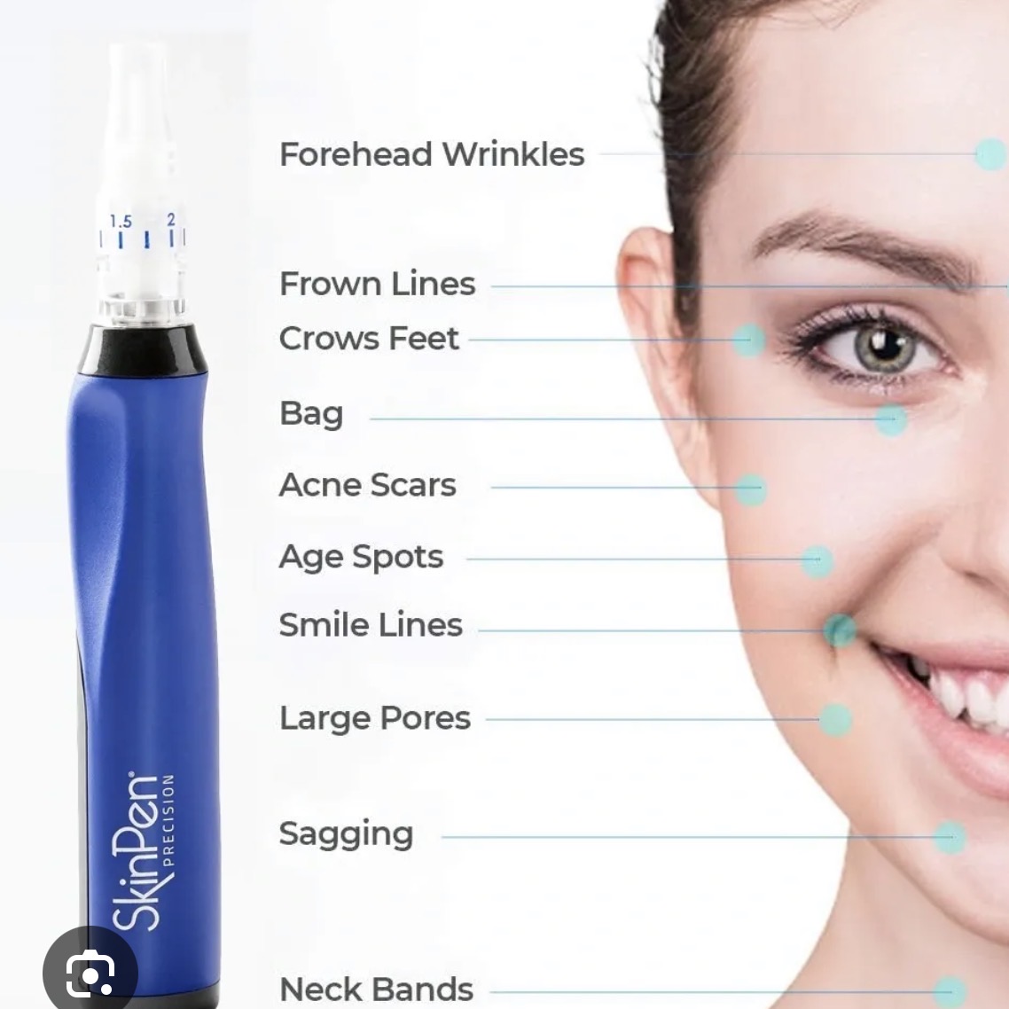SkinPen microneedling treatment areas diagram